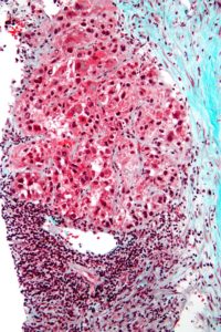 magnification micrograph of hepatocellular carcinoma