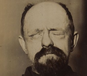 picture of a man suffering from right facial palsy