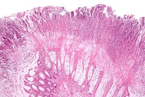 micrograph of colonic pseudomembranes