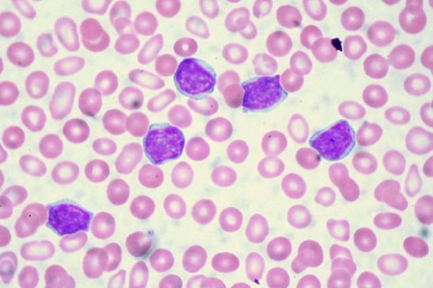 Chronic Lymphocytic Leukemia (CLL) — Staging and Prognosis | Lecturio