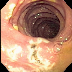 multiple small ulcers located in the distal duodenum multiple small ulcers located in the distal duodenum