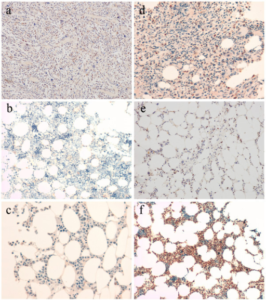 myelodysplastic syndrome with 5q- and additional cytogenetic abnormalities