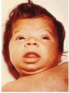 myxedematous facies, macroglossia, and skin mottling