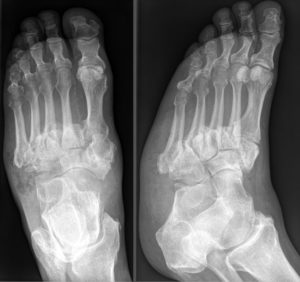 Diabetes Complications: Diabetic Retinopathy, Nephropathy & Neuropathy