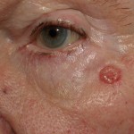 Nodular Basal cell carcinoma in 75-year-old man Nodular Basal cell carcinoma in 75-year-old man