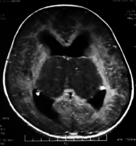 pediatric glioma