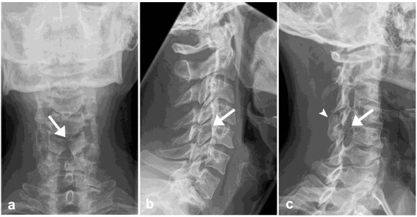 Plain Radiographs of the cervical spine