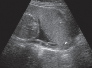 placenta previa x-ray placenta previa x-ray