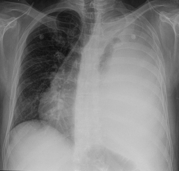 Pleural Effusion — Diagnoses, Treatment, Transudate, and Exudate