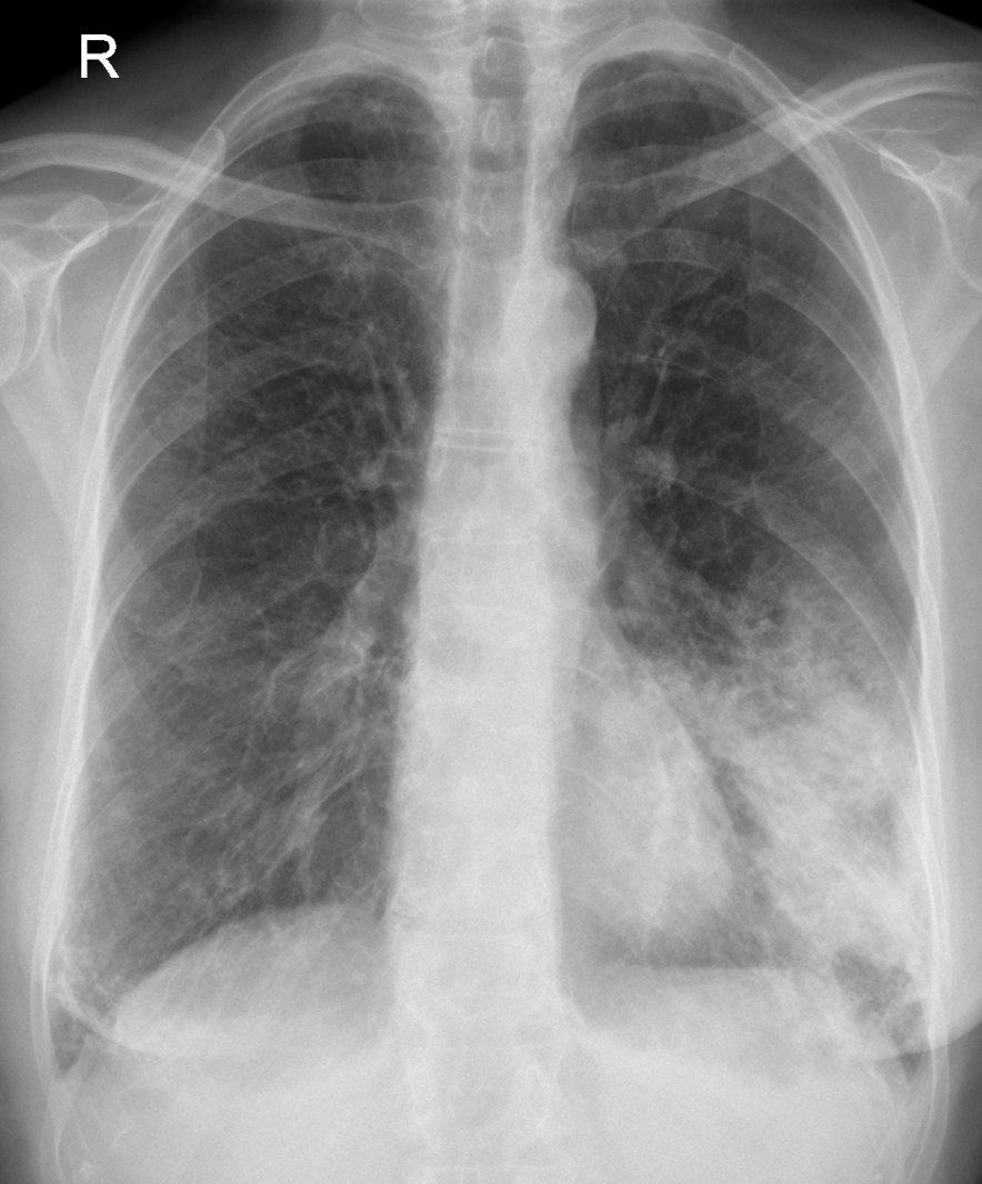 bacterial pneumonia chest x ray findings