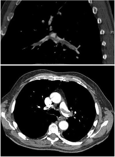 pulmonary angiography