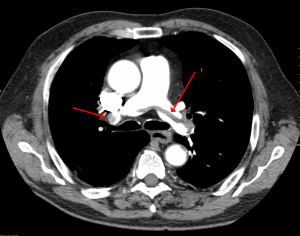 pulmonary embolism