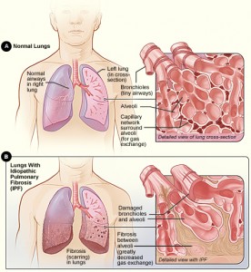 pulmonary fibrosis pulmonary fibrosis