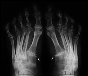 rheumatoid arthritis