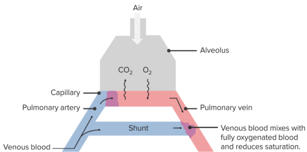 alveolar arterial gradient shunt vs. dead space ventilation