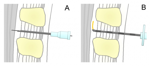 schematic representation of the spinal (A) and epidural (B) in comparison. Shown is a median section in the sagittal plane ( height mean lumbar spine )
