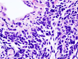 small cell carcinoma