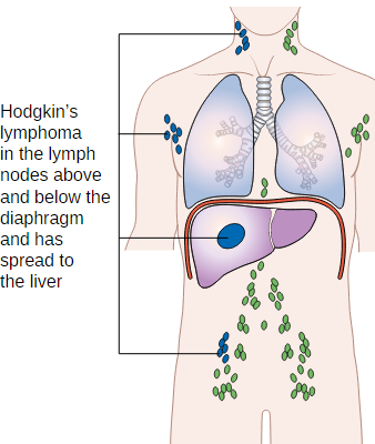 Hodgkin's Lymphoma (Hodgkin's Disease) — Stages and Classification