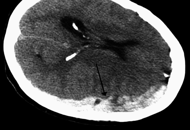 Hematoma subdural