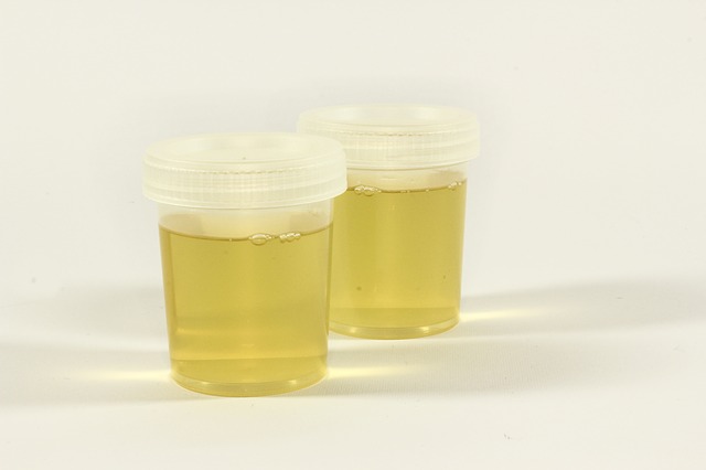 Proteinuria Protein In Urine In Children Symptoms Treatment