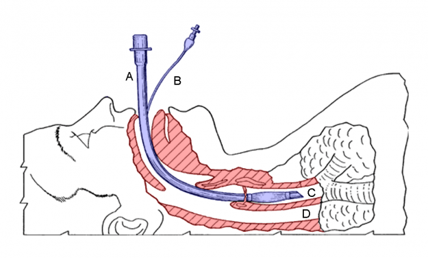 Diagram of an inserted endotracheal tube Diagram of an inserted endotracheal tube