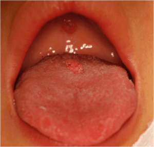 tongue-with-a-pedicled-base