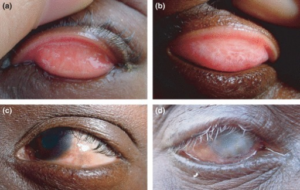 Image: "Clinical features of trachoma. (a) Active trachoma in a child, characterised by a mixed papillary (TI) and follicular response (TF). (b) Tarsal conjunctival scarring (TS). (c) Entropion and trichiasis (TT). (d) Blinding corneal opacification (CO) with entropion and trichiasis (TT)." by Openi. Licence: CC BY 2.5