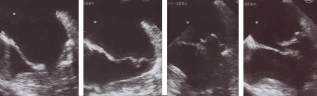 transesophageal echocardiogram of mitral valve prolapse transesophageal echocardiogram of mitral valve prolapse