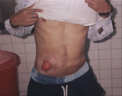 transverse colostomy on the right side