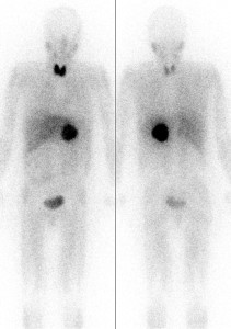 tumor of the left adrenal glands (pheochromocytoma)