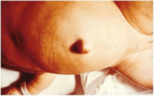 untreated CH
