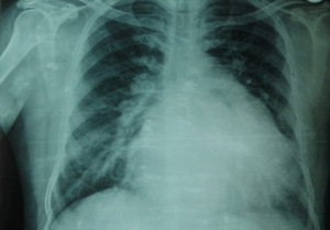 x-ray-lung