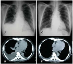 x-ray successful management of refractory pleural effusion