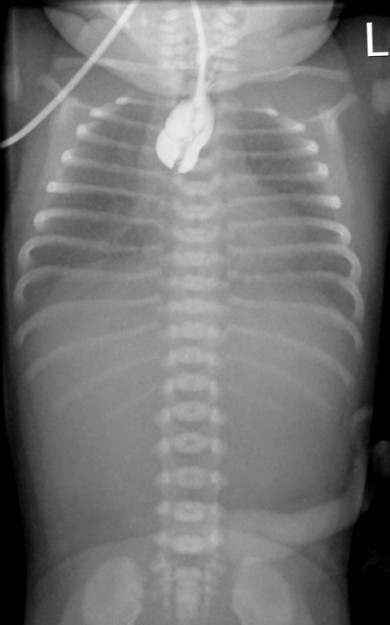 Esophageal Atresia Type 2 Esophageal Atresia Type 2