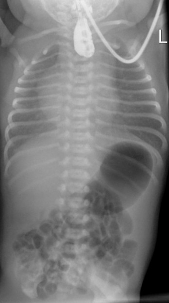 Esophageal Atresia Type 3b Esophageal Atresia Type 3b